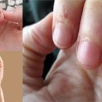 Removing cuticles