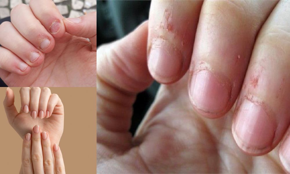 Removing cuticles